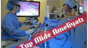 Tüp Mide Ameliyatı Hakkında Bilgi
